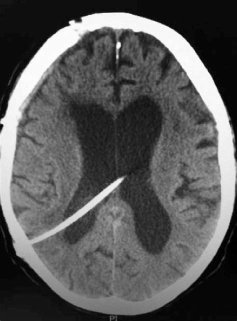 Ventriculo Peritoneal Shunt Placement To Treat Hydrocephalus
