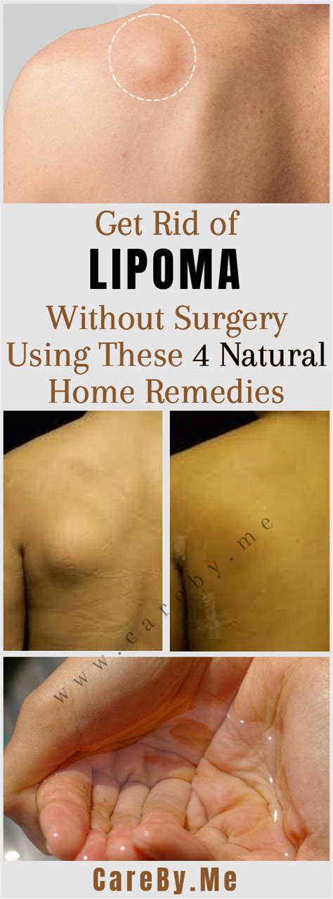 Get Rid Of Lipoma Without Surgery Using These 4 Natural Home Remedies