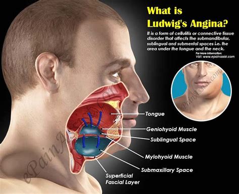 Ludwigs Angina Symptoms Causes Treatment Prognosis Epidemiology