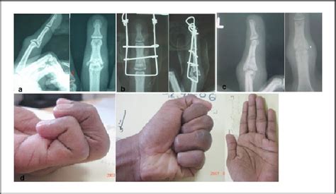 The Use Of Dynamic External Fixation In The Treatment Of Dorsal