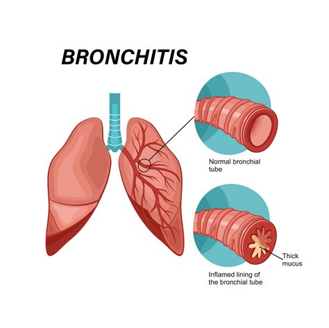 Bronchitis — El Paso Pulmonary Association