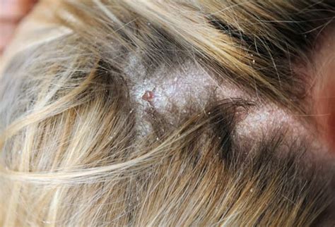 Scalp Problems · Northants Hair And Scalp Clinic