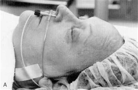 There are three main proposed benefits of. Nasal Cannula Fio2