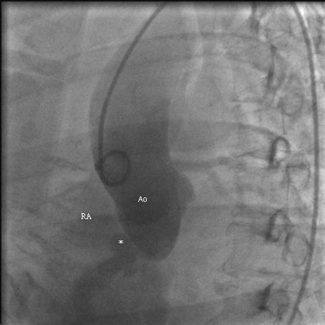 Ruptured Noncoronary Sinus Of Valsalva Aneurysm Circulation Heart