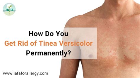 Tinea Versicolor Before And After