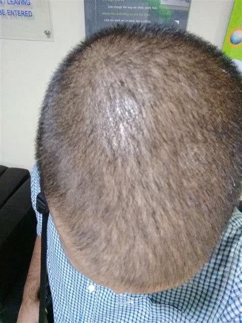 Hair thinning is a symptom of hair loss. Fine Hair Or Diffuse Thinning/ Male Pattern Baldness ...