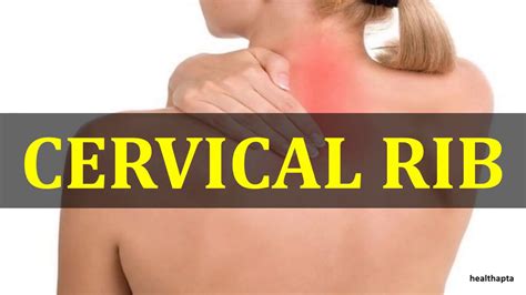 Cervical Rib Youtube