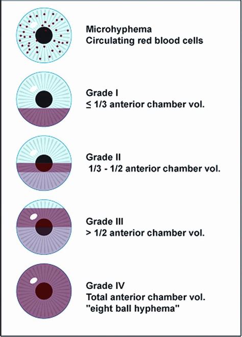 Hyphema Grading System Eye Health Facts Optometry Education Medical