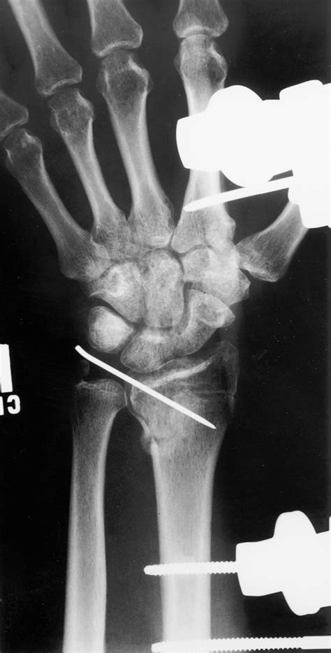 3 Fracture Fixation Radiology Key