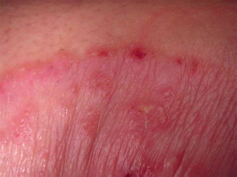 Armpit Rash Causes And Treatments