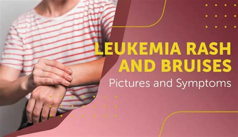 Leukemia Rash And Bruises Pictures And Symptoms Myleukemiateam