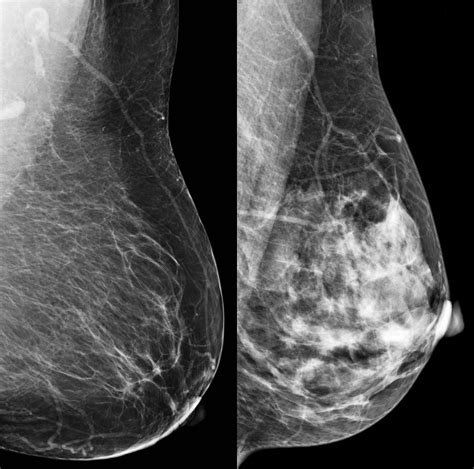Triad Doctor Explains Breast Density Increased Risk For Patients
