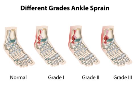 The 3 Grades Of An Ankle Sprain And How Chiropractic Can Help Tri State