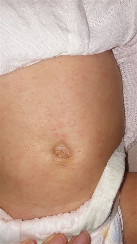 Heat Rash Eczema Help — The Bump