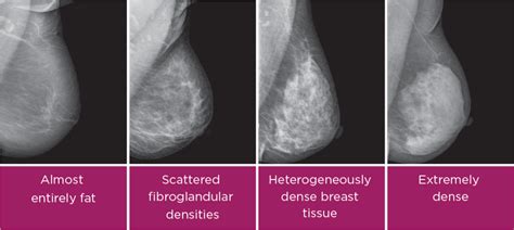 breast density understanding its significance and impact on breast health consulting radiologists