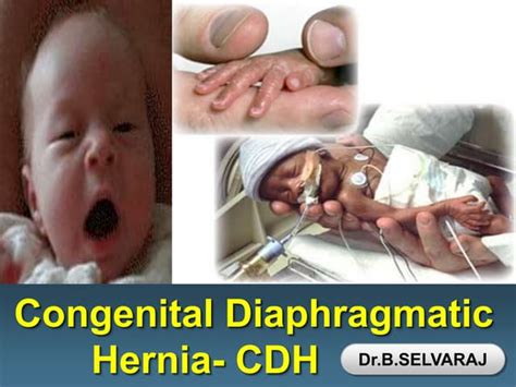 Congenital Diaphragmatic Hernia Pediatric Surgery Ppt