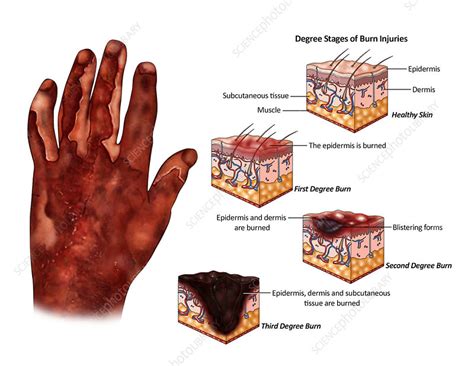 Degree Stages Of Burn Injuries Illustration Stock Image C0393474