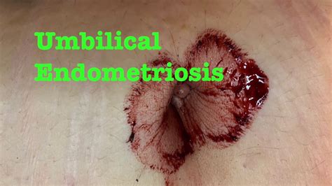 Endo belly is the severe bloating that endometriosis causes and can last for hours, days, or weeks. Umbilical (Belly Button) Endometriosis - YouTube