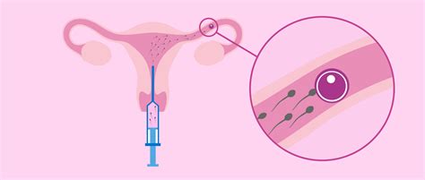 What Is Intrauterine Artificial Insemination