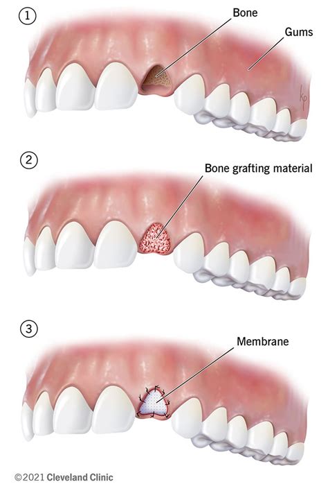 How Successful Is Dental Bone Grafting Dentist Norcross And Alpharetta Ga
