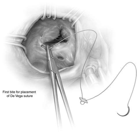 Tricuspid Valve Repair—indications And Techniques Suture Annuloplasty