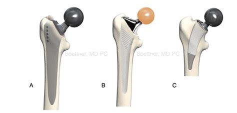 Posterior Hip Replacement Posterior Hip Surgery New York Ny