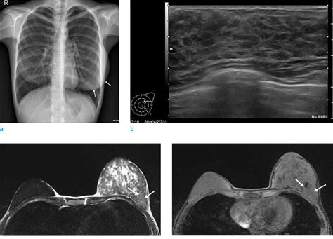 Pdf A Case Report Of Juvenile Hypertrophy Of The Breast In A 15 Year