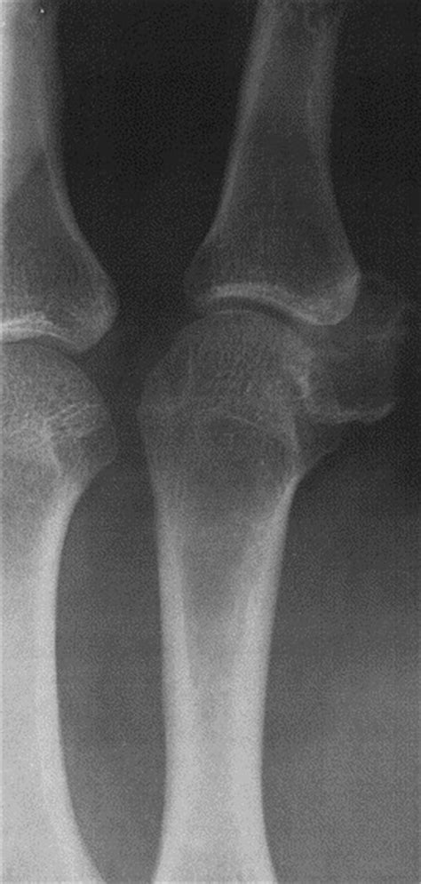 Aneurysmal Bone Cyst Of The Index Sesamoid Journal Of Hand Surgery