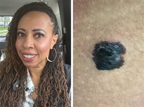 a woman thought a spot she d had for years was a birthmark — until it started bleeding when she