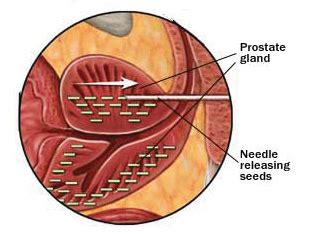 Brachytherapy Prostate Cancer Treatment Houston Hifu Prostate Serviceshifu Prostate Services