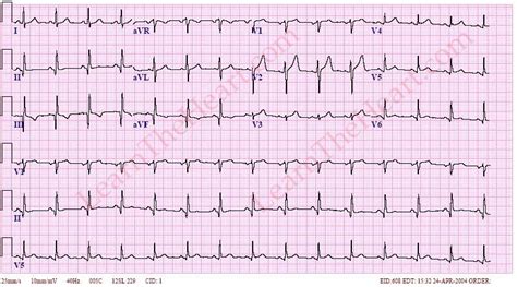Old Inferior Wall Mi Ecg Example 2 Learn The Heart