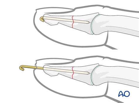 K Wire Fixation For Distal Phalanx Distal And Shaft Transverse