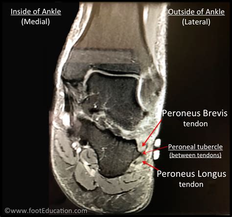 Peroneal Tendonitis Footeducation