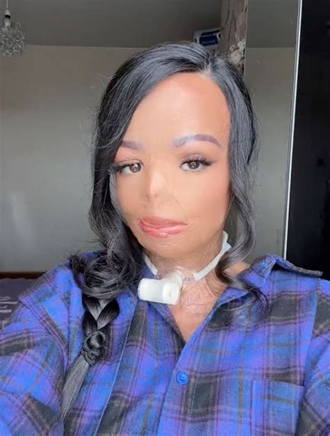 Teen Burn Victim Becomes Unexpected Beauty Influencer On Tiktok Chic Fashion