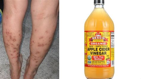 Itchy skin conditions such as eczema can cause a continuous urge to scratch the skin, ultimately leading to dark spots on legs or any other part of the. Home Remedies Series || Get Rid of Dark Spots On Legs ...