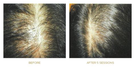 Microneedling can also work to reduce cellulite. Meso Hair Micro-Needling For Hair Loss Treatment | Papilla Haircare