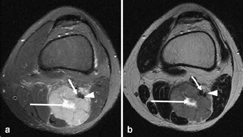 Mr Imaging Of Tibial Nerve Entrapment Near The Popliteal Fossa Axial
