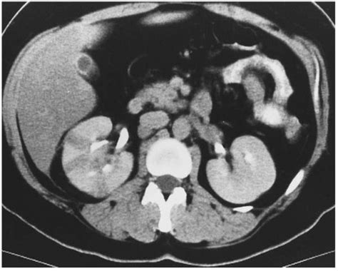 Renal Inflammatory Disease Radiology Key