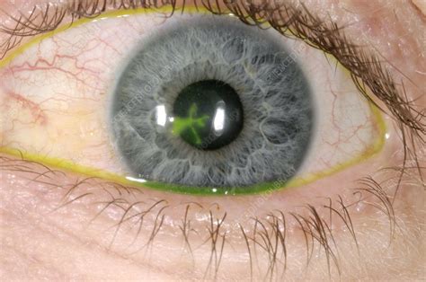 Eye Ulcer Stock Image C0024931 Science Photo Library