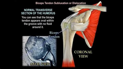 Biceps Tendon Subluxation Or Dislocation —