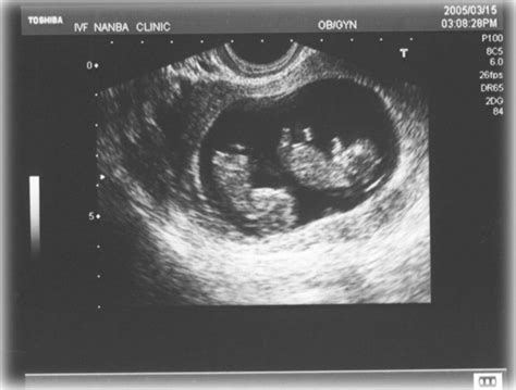 Transvaginal Ultrasound At 1037 Weeks Of Gestation A Thin Septum
