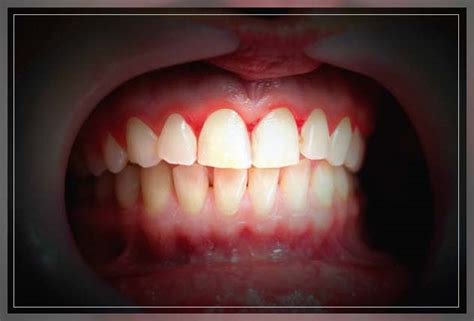 How To Prevent Gum Infection Dentist Ahmed Official Website