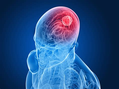 Brain Cancer Causes Symptoms And Treatment Live Science