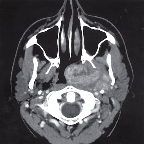 Radiology Quiz Case 2 Jama Otolaryngologyhead And Neck Surgery Jama Network