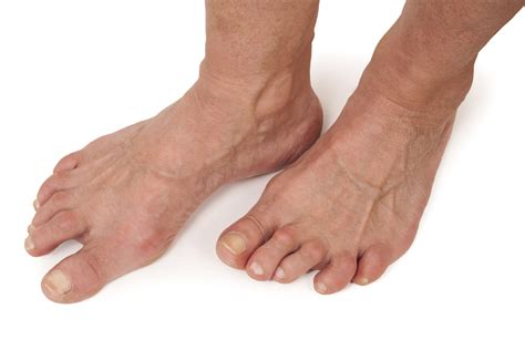 Rheumatoid Arthritis Of The Foot Net Health Book