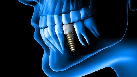 Dental Implants Dentist In Birmingham Greystone Smile Design