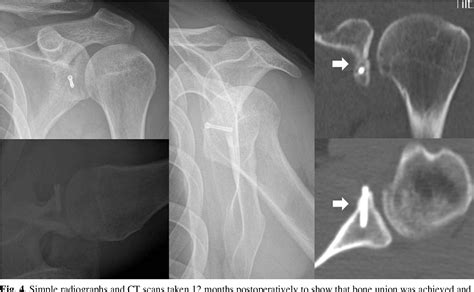 Figure 2 From Treatment Of Anterior Glenoid Rim Fracture With