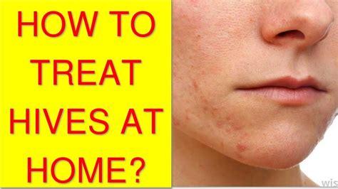 Hives Treatment Click Here And Discover How