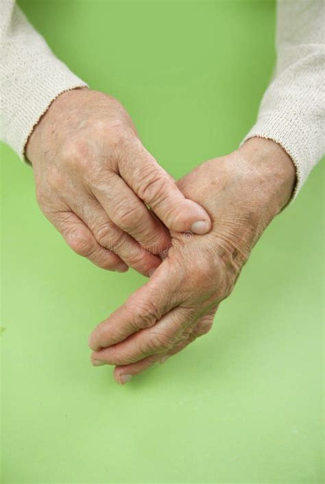 Mains De Femme Déformées Du Rhumatisme Articulaire Photo Stock Image Du Difformité Patient