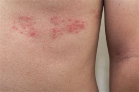 Urgent Care For Shingles Monte Sances